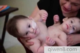 女子产下连体双胞胎，如今手术前夕，母亲却犹豫的揪心般难受
