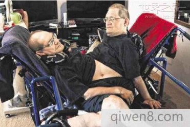 世界最长寿连体兄弟
