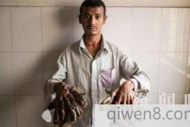 孟加拉“树人”手术成功 切除“树根”展笑颜