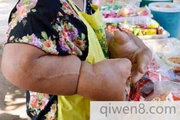 泰国女子患病创世界上最大的手臂