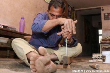 世界指头最多的人 来自印度的木匠有28个指头(患...
