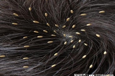 自然界中让人讨厌的一种生物 虱子寄生在人身上(...