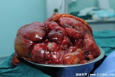 世界上十大最可怕的疾病 心脏病死亡率较高(慢性...