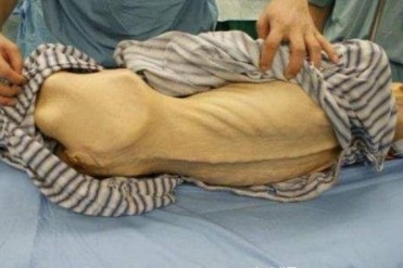 世界上最瘦的男人 体重只有41公斤(患有厌食症)