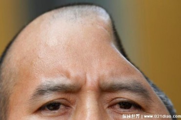 世界上最奇特的脑袋 脑袋剩下一半被称半脑哥(并...