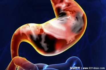 世界上十大年轻人常见疾病 脱发越来越年轻化(影...